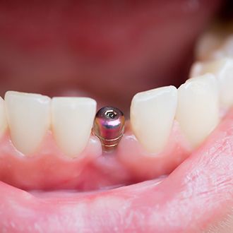 dental implant in patients mouth 