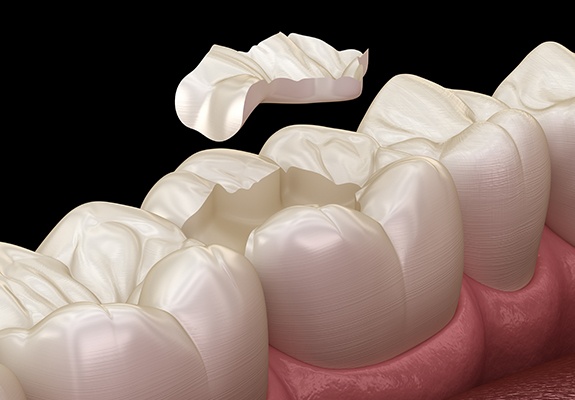 Animated smile during all ceramic dental restoration process