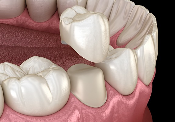 Animated smile during all ceramic dental crown placement