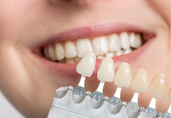 Smile compared with porcelain veneers color chart