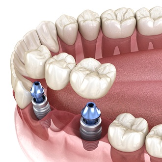 A digital image showing a dental implant bridge sitting in the lower arch in Zionsville