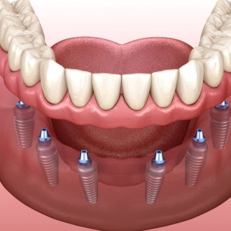 A digital scan of 6 dental implants on the lower arch of the mouth and full dentures attached in Zionsville