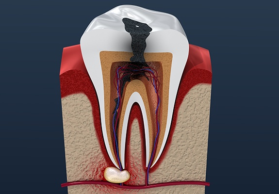 Animated tooth with severe decay in need of root canal therapy