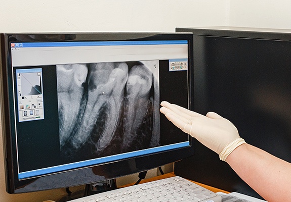 Digital dental x-rays on computer screen