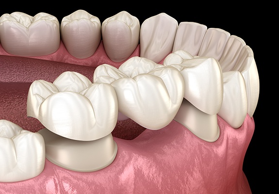Animated smile with dental bridge restoration