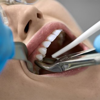 tooth extraction option when considering cost of root canal therapy  