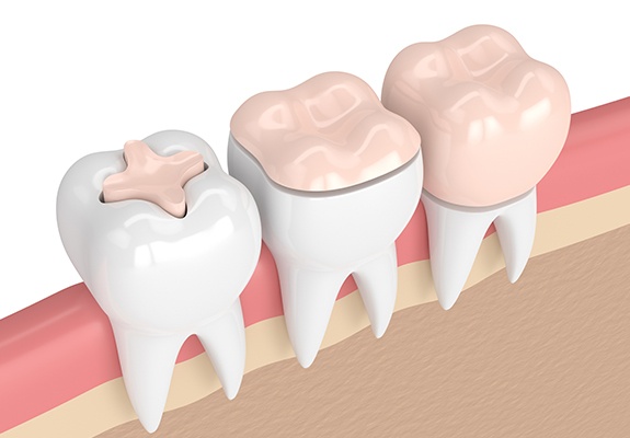 Animated smile comparing dental crowns to other restorations