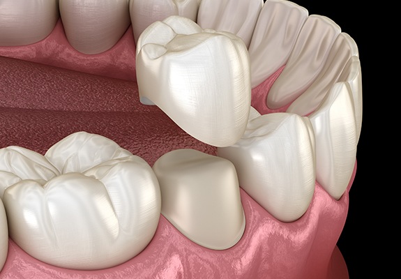 Animated smile during dental crown placement