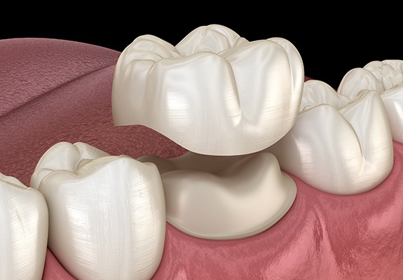 Animated smile during dental crown placement