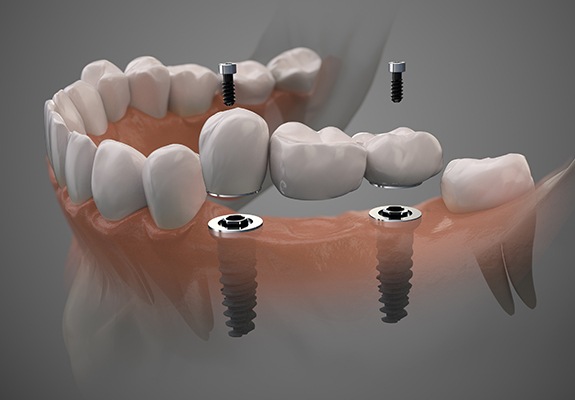 Animated smile during fixed bridge placement