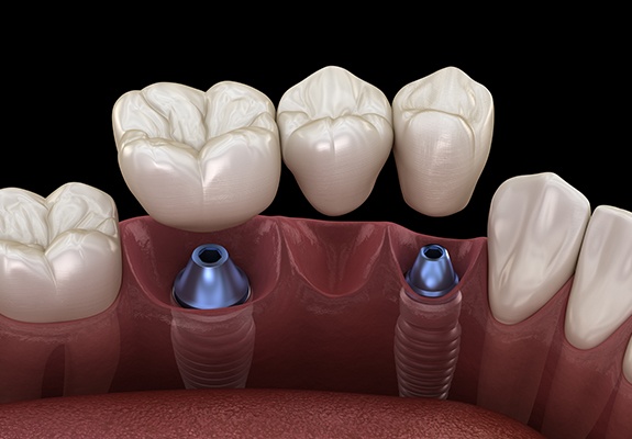 Animated smile showing crown and bridge restoration process