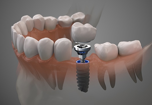 Animated smile during dental implant supported dental crown placement