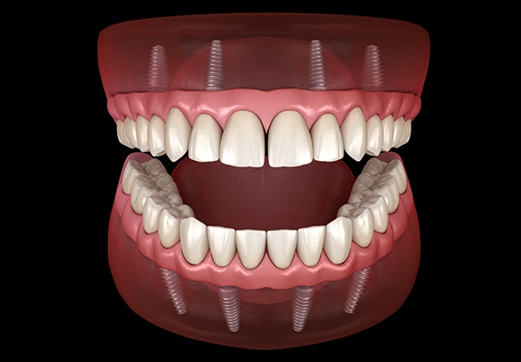 Animated smile with dental implant supported dentures