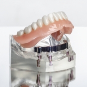 Model dental implant retained denture