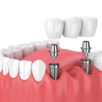 implant bridge illustration for cost of dental implants in Zionsville