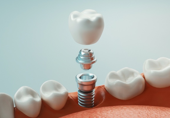 Animated smile during dental implant supported dental crown placement