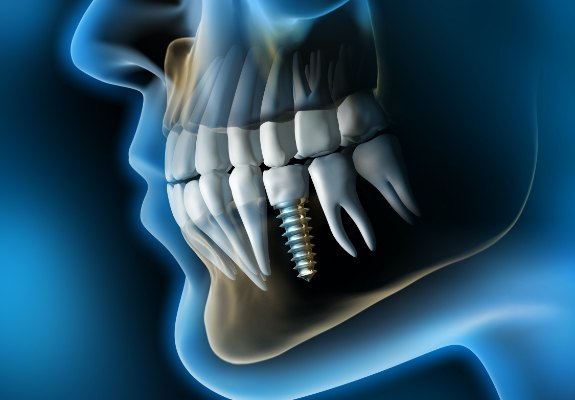 Animated smile after dental implant tooth replacement