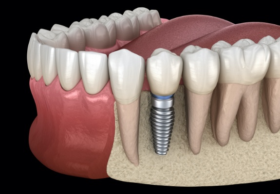 Animated smile with dental implant supported dental crown in place