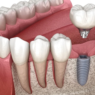A single dental implant in Zionsville located in the lower arch of the mouth