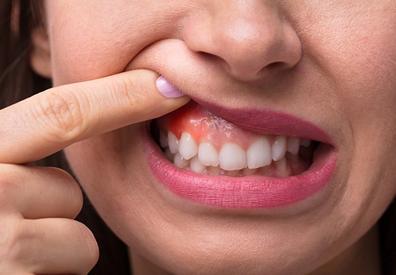 Closeup of smile with inflamed gum tissue before periodontal therapy