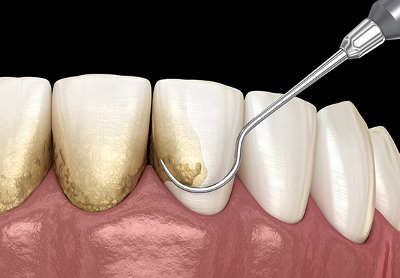 Animated smile during scaling and root planing