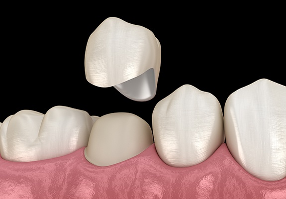 Animated smile during dental crown restorative dentistry treatment