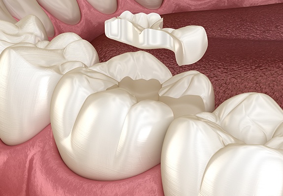 Animated smile during tooth colored filling placement