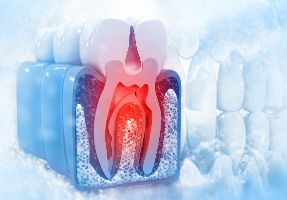 Animated damaged tooth prior to root canal therapy