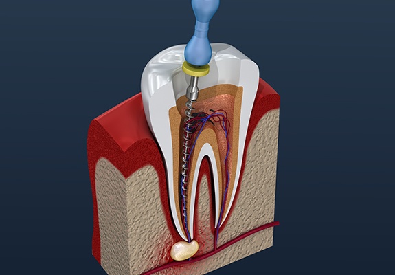 Animated smile during root canal therapy