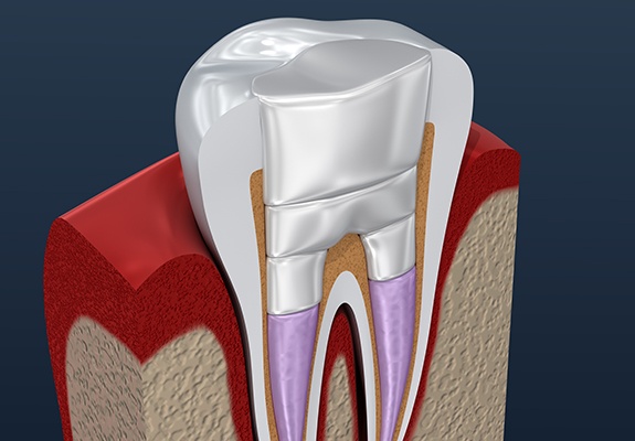 Animated tooth after root canal therapy