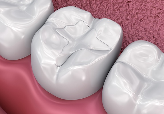 Animated smile with dental sealants in place