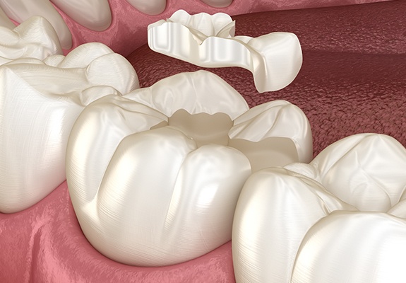 Animated smile during tooth colored filling placement