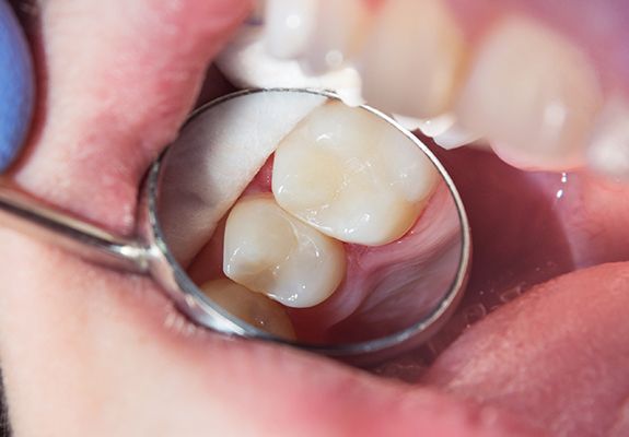 Dentist examining smile after tooth colored filling restoration