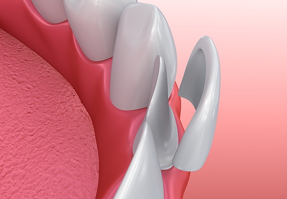 Animated smile during individual porcelain veneer placement