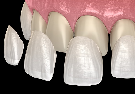 Animated smile during multiple porcelain veneer placement