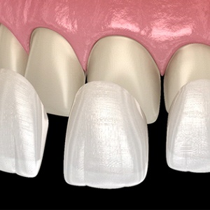 A digital image of porcelain veneers in Zionsville being placed over natural teeth in Zionsville