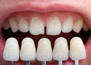 shade determination for dental crowns