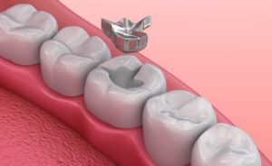 A diagram of a dental filling.