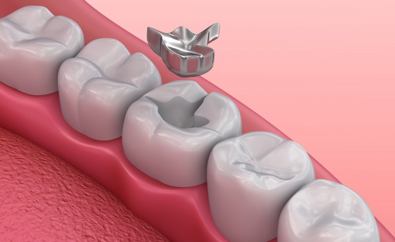dental cement filling