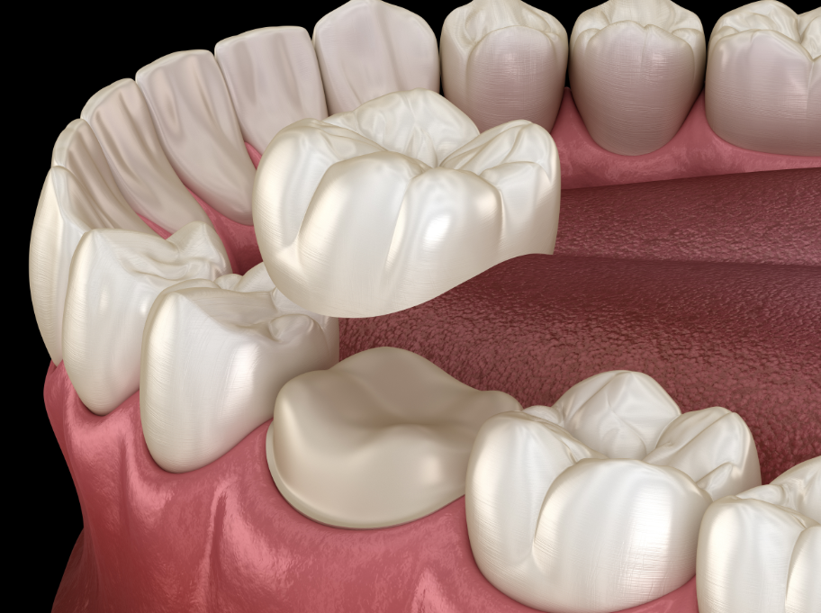 3D image of a dental crown